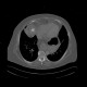 Chondroma of lung, gigantic: CT - Computed tomography